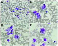 Signet-ring histiocytes in typhoid fever