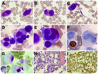 Circulating hypergranular neoplastic cells: not always leukemic promyelocytes