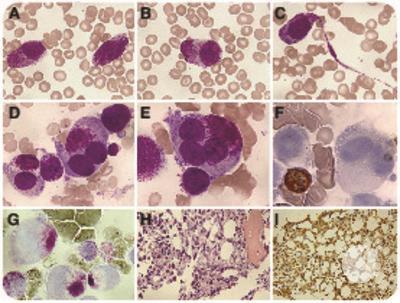 Circulating hypergranular neoplastic cells: not always leukemic promyelocytes