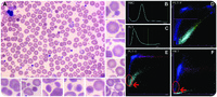 Acquired “pyro”-poikilocytosis