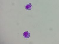 CSF plasmacytosis
