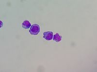 CSF plasmacytosis