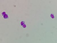 CSF plasmacytosis