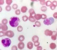Giant platelets 1