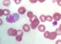 Giant platelets 2