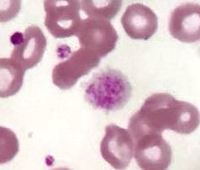 Giant platelets 3