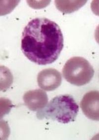 Giant platelets 5