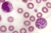 Giant platelets 6
