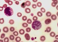 Giant platelets 7