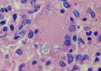 Histoplasmosis - Trephine