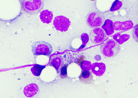 Histoplasmosis - Aspirate