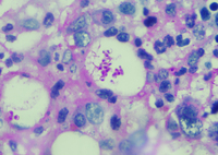 Histoplasmosis - PAS stain