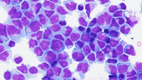 CNS Peripheral T-Cell Lymphoma