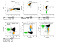 CNS Peripheral T-Cell Lymphoma