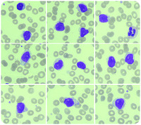 When a marginal zone–type lymphocytosis mimics large granular lymphocytes