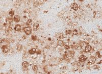 S100 immunostain