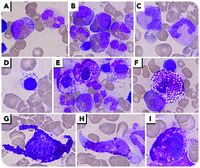 A “foamy” mastocytosis case