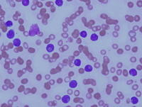 blast peripheral blood