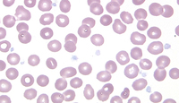 Gray-Platelet syndrome