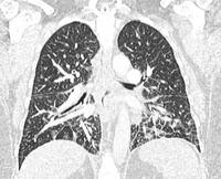 Ct scan of the lung