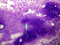 Metastatic breast cancer cells