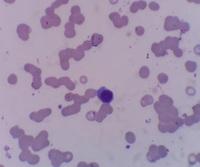 plasma cell leukemia manifestation in peripheral blood 1