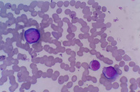 plasma cell leukemia manifestation in peripheral blood 2