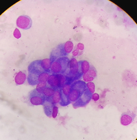 Osteoblasts in BM 1