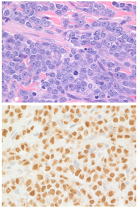 Myeloid sarcoma t(8;21)