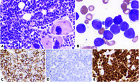 B-cell acute lymphoblastic leukemia in JAK2 V617F–positive polycythemia vera