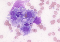 Erythrophagocytosis