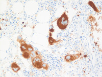 CD61 stain in PV