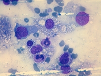 Hemophagocytosis