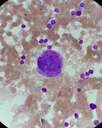 ITP megakaryocyte morphology 1