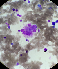 ITP megakaryocyte morphology 6