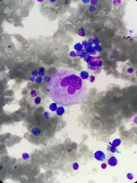 ITP megakaryocyte morphology