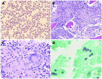 Unusual cause of infant pancytopenia: granulomatous bone marrow lesion with disseminated histoplasmosis