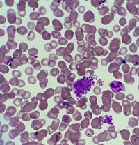 Clumps of platelets in peripheral blood smear