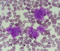 Clumps of platelets in peripheral blood smear