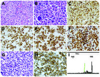 An anaplastic T-cell lymphoma mimicking classical Hodgkin lymphoma