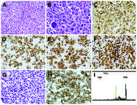 An anaplastic Tcell lymphoma mimicking classical Hodgkin