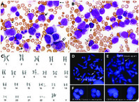 Acute myeloid leukemia with coexistence of t(9;22) and inv(16)