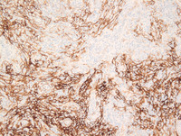 AITL (CD21)