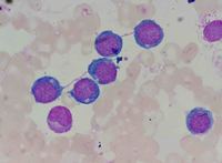 bone marrow changes in megaloblastic anemia 4