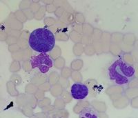 Marrow involvement in cutaneous T-cell lymphoma