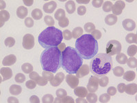 Blasts with dysplastic neutrophils