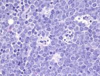 Burkitt Lymphoma