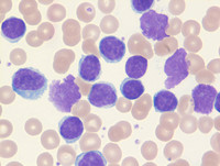 CLL - Smudge cells