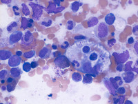 Hemophagocytosis