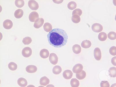 LGL - Large granular lymphocyte